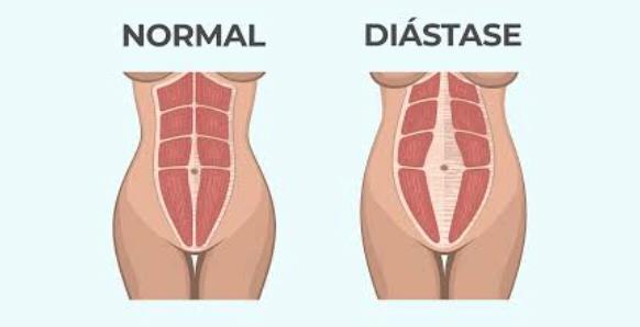 À esquerda mostra-se um abdome sem diástase e à direita com diástase abdominal