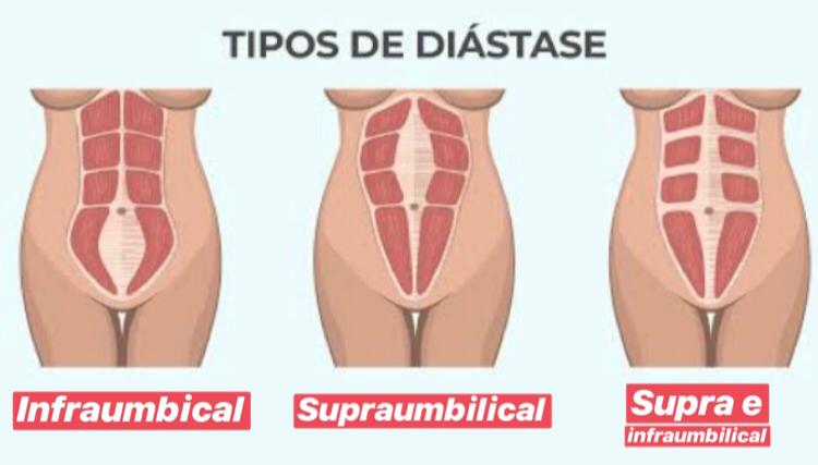 A imagem mostra os tipos de diástase abdominal